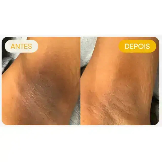 Before and after armpit skin tone brightening with Adeus Dark Spot Correcting Cream - Buy now at MKPBR.COM - Worldwide Shipping