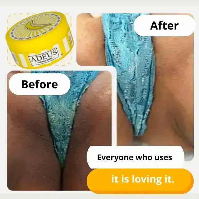 Before and after results using Adeus Dark Spot Correcting Cream for bikini and intimate area brightening - Buy now at MKPBR.COM - Worldwide Shipping