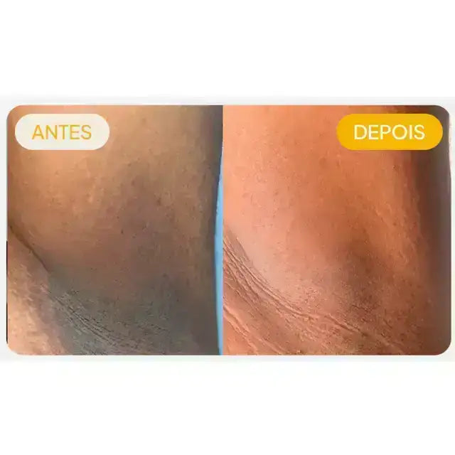 Underarm dark spot before and after results with Adeus Dark Spot Correcting Cream safe for sensitive skin - Buy now at MKPBR.COM - Worldwide Shipping