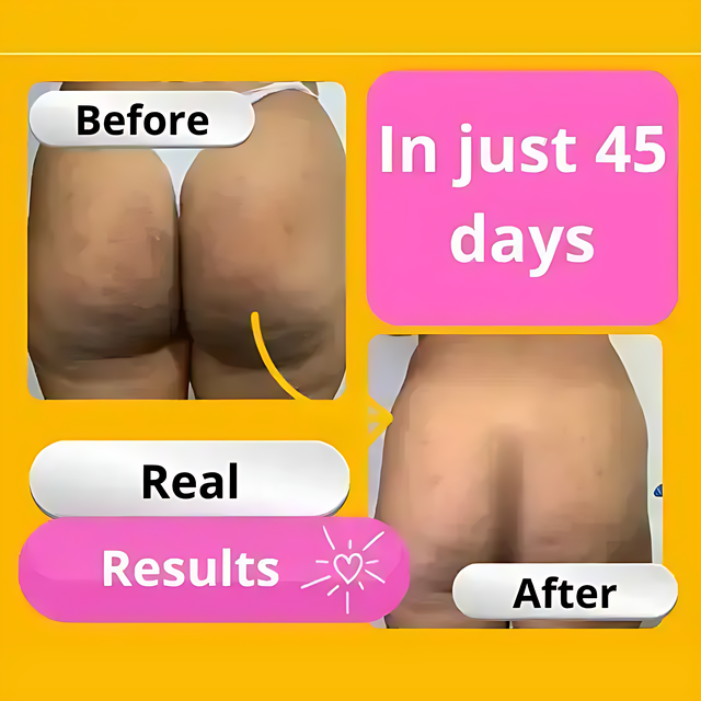 Before and after results in 45 days using Adeus Dark Spot Correcting Cream for body and intimate areas - Buy now at MKPBR.COM - Worldwide Shipping