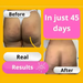 Before and after results in 45 days using Adeus Dark Spot Correcting Cream for body and intimate areas - Buy now at MKPBR.COM - Worldwide Shipping