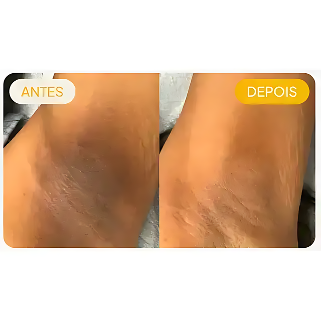 Before and after armpit skin tone brightening with Adeus Dark Spot Correcting Cream - Buy now at MKPBR.COM - Worldwide Shipping