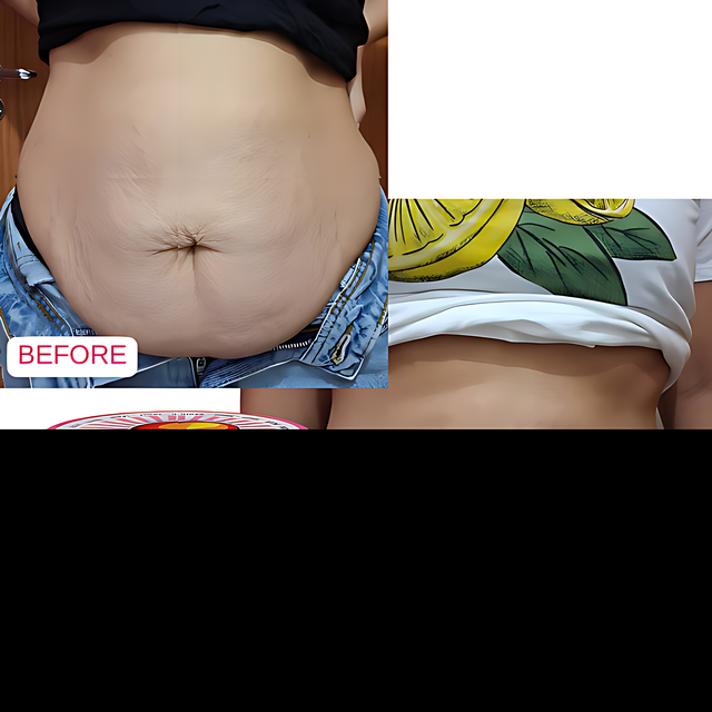 Adeus Multi-Action Intensive Body Cream for Cellulite and Stretch Marks – 10.58 oz (300g). Before and after comparison showing smoother, firmer skin results with visible cellulite reduction – Buy now at MKPBR.COM – Worldwide Shipping