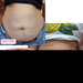 Adeus Multi-Action Intensive Body Cream for Cellulite and Stretch Marks – 10.58 oz (300g). Before and after comparison showing smoother, firmer skin results with visible cellulite reduction – Buy now at MKPBR.COM – Worldwide Shipping