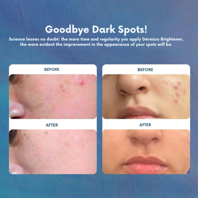 Cicatribem Dermal Brightening Cream for Dark Spots & Melasma, 2.12 oz (60 g) – open jar showing texture – Buy now at MKPBR.COM – Worldwide Shipping
