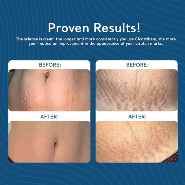 Cicatribem Regenerador Dérmico Anti-Stretch Mark Body Cream, 5.29 oz (150 g) – belly application during body-care routine – Buy now at MKPBR.COM – Worldwide Shipping
