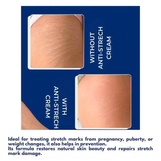 Lipo Corpus Anti-Stretch Mark Cream 8.82 oz (250g) – Prevents new stretch marks – Buy now at MKPBR.COM – Worldwide Shipping