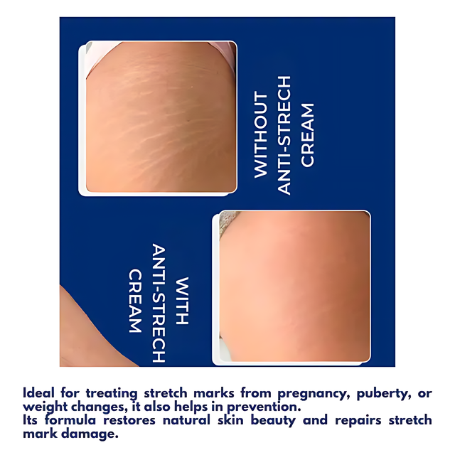 Lipo Corpus Anti-Stretch Mark Cream 8.82 oz (250g) – Prevents new stretch marks – Buy now at MKPBR.COM – Worldwide Shipping
